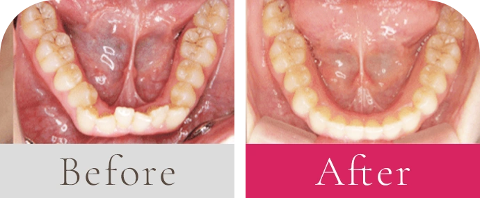 過蓋咬合 前歯のガタガタビフォーアフター