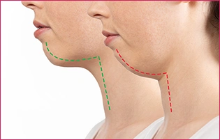 アデノイド顔貌